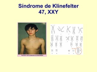 Síndrome de Klinefelter
47, XXY
 