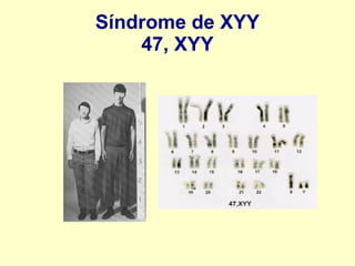 Síndrome de XYY
47, XYY
 