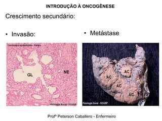 INTRODUÇÃO À ONCOGÊNESE

Crescimento secundário:

• Invasão:                      • Metástase




             Profº Peterson Caballero - Enfermeiro
 