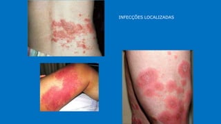 INFECÇÕES LOCALIZADAS
 
