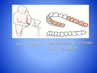 10 to 11 o ̓clock Turned toward the clinician
Chin – Up position
 