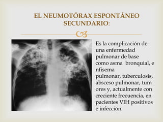 EL NEUMOTÓRAX ESPONTÁNEO
       SECUNDARIO:
         
              Es la complicación de
              una enfermedad
              pulmonar de base
              como asma bronquial, e
              nfisema
              pulmonar, tuberculosis,
              absceso pulmonar, tum
              ores y, actualmente con
              creciente frecuencia, en
              pacientes VIH positivos
              e infección.
 