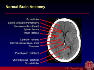 OU Neurology
Normal Brain Anatomy
Lateral ventricle (frontal horn)
Frontal lobe
Caudate nucleus (head)
Sylvian fissure
Insula (cortex)
Lentiform nucleus
Internal capsule (post. limb)
Thalamus
Pineal gland (calcified)
Choroid plexus (calcified)
Occipital lobe
 