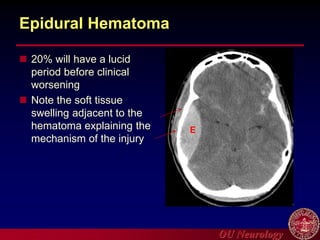 OU Neurology
Epidural Hematoma
 20% will have a lucid
period before clinical
worsening
 Note the soft tissue
swelling adjacent to the
hematoma explaining the
mechanism of the injury
E
 