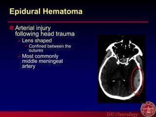 OU Neurology
Epidural Hematoma
 Arterial injury
following head trauma
Lens shaped
 Confined between the
sutures
Most commonly
middle meningeal
artery
 