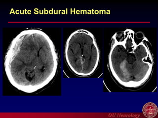 OU Neurology
Acute Subdural Hematoma
 