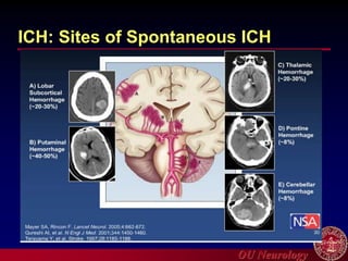 OU Neurology
ICH: Sites of Spontaneous ICH
 