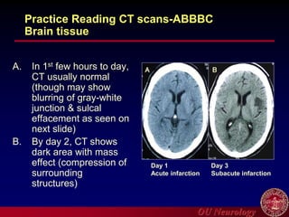 OU Neurology
Practice Reading CT scans-ABBBC
Brain tissue
A. In 1st few hours to day,
CT usually normal
(though may show
blurring of gray-white
junction & sulcal
effacement as seen on
next slide)
B. By day 2, CT shows
dark area with mass
effect (compression of
surrounding
structures)
Day 3
Subacute infarction
Day 1
Acute infarction
A B
 