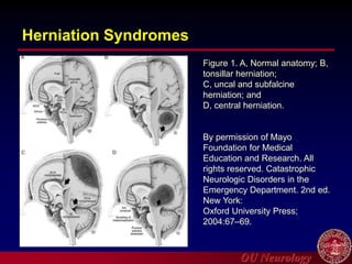 OU Neurology
Figure 1. A, Normal anatomy; B,
tonsillar herniation;
C, uncal and subfalcine
herniation; and
D, central herniation.
By permission of Mayo
Foundation for Medical
Education and Research. All
rights reserved. Catastrophic
Neurologic Disorders in the
Emergency Department. 2nd ed.
New York:
Oxford University Press;
2004:67–69.
Herniation Syndromes
 