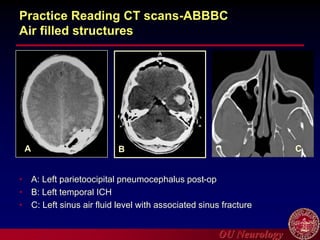 OU Neurology
Practice Reading CT scans-ABBBC
Air filled structures
• A: Left parietoocipital pneumocephalus post-op
• B: Left temporal ICH
• C: Left sinus air fluid level with associated sinus fracture
A B C
 