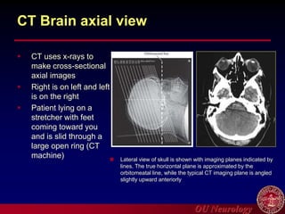OU Neurology
CT Brain axial view
 CT uses x-rays to
make cross-sectional
axial images
 Right is on left and left
is on the right
 Patient lying on a
stretcher with feet
coming toward you
and is slid through a
large open ring (CT
machine)  Lateral view of skull is shown with imaging planes indicated by
lines. The true horizontal plane is approximated by the
orbitomeatal line, while the typical CT imaging plane is angled
slightly upward anteriorly
 