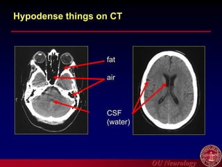 OU Neurology
Hypodense things on CT
fat
air
CSF
(water)
 
