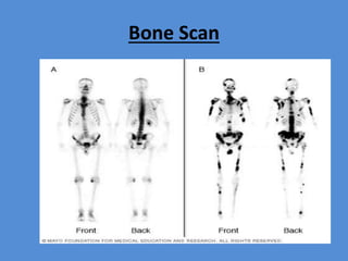 Bone Scan
 