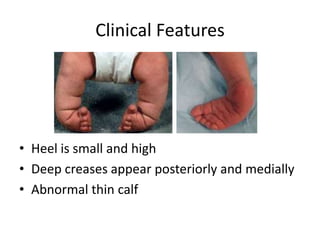 Congenital Tallipes Equino Varus (CTEV) | PPTX