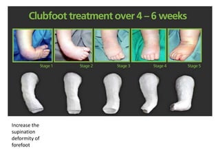 Congenital Tallipes Equino Varus (CTEV) | PPTX