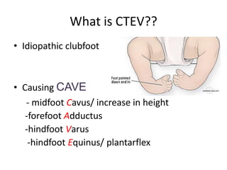 Ctev Types Congenital Tallipes Equino Varus (CTEV) | PPTX