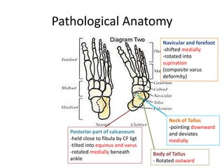 Pathological Anatomy
Neck of Tallus
-pointing downward
and deviates
medially
Body of Tallus
- Rotated outward
Posterior pa...