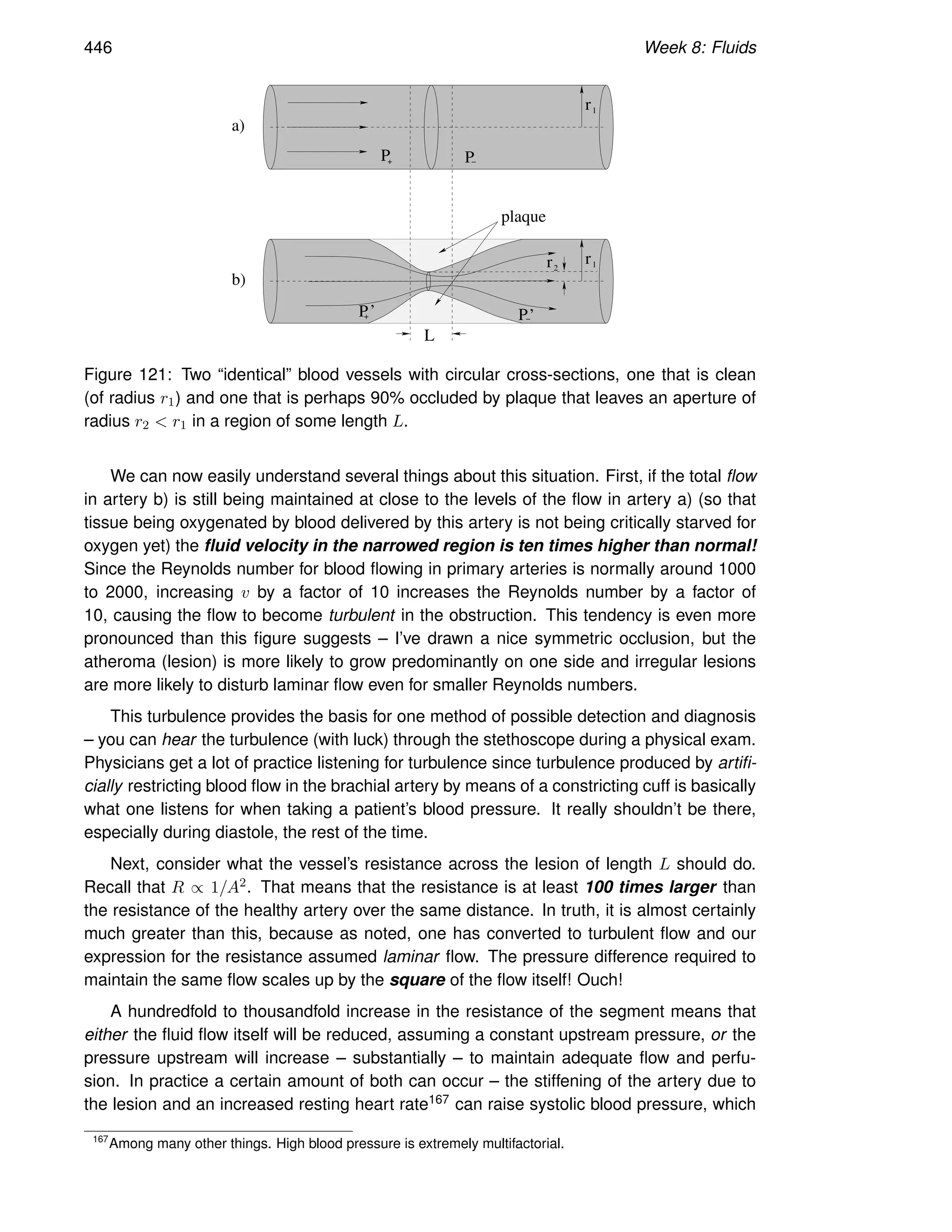 446 Week 8: Fluids
r
2
r r1
1
L
P+ P−
P
+ P−
’ ’
a)
b)
plaque
Figure 121: Two “identical” blood vessels with circular cross-sections, one that is clean
(of radius r1) and one that is perhaps 90% occluded by plaque that leaves an aperture of
radius r2  r1 in a region of some length L.
We can now easily understand several things about this situation. First, if the total flow
in artery b) is still being maintained at close to the levels of the flow in artery a) (so that
tissue being oxygenated by blood delivered by this artery is not being critically starved for
oxygen yet) the fluid velocity in the narrowed region is ten times higher than normal!
Since the Reynolds number for blood flowing in primary arteries is normally around 1000
to 2000, increasing v by a factor of 10 increases the Reynolds number by a factor of
10, causing the flow to become turbulent in the obstruction. This tendency is even more
pronounced than this figure suggests – I’ve drawn a nice symmetric occlusion, but the
atheroma (lesion) is more likely to grow predominantly on one side and irregular lesions
are more likely to disturb laminar flow even for smaller Reynolds numbers.
This turbulence provides the basis for one method of possible detection and diagnosis
– you can hear the turbulence (with luck) through the stethoscope during a physical exam.
Physicians get a lot of practice listening for turbulence since turbulence produced by artifi-
cially restricting blood flow in the brachial artery by means of a constricting cuff is basically
what one listens for when taking a patient’s blood pressure. It really shouldn’t be there,
especially during diastole, the rest of the time.
Next, consider what the vessel’s resistance across the lesion of length L should do.
Recall that R ∝ 1/A2. That means that the resistance is at least 100 times larger than
the resistance of the healthy artery over the same distance. In truth, it is almost certainly
much greater than this, because as noted, one has converted to turbulent flow and our
expression for the resistance assumed laminar flow. The pressure difference required to
maintain the same flow scales up by the square of the flow itself! Ouch!
A hundredfold to thousandfold increase in the resistance of the segment means that
either the fluid flow itself will be reduced, assuming a constant upstream pressure, or the
pressure upstream will increase – substantially – to maintain adequate flow and perfu-
sion. In practice a certain amount of both can occur – the stiffening of the artery due to
the lesion and an increased resting heart rate167 can raise systolic blood pressure, which
167
Among many other things. High blood pressure is extremely multifactorial.
 