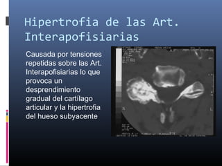 Hipertrofia de las Art.
Interapofisiarias
Causada por tensiones
repetidas sobre las Art.
Interapofisiarias lo que
provoca un
desprendimiento
gradual del cartílago
articular y la hipertrofia
del hueso subyacente
 