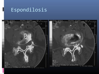 Espondilosis
 