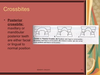 Crossbites
• Posterior
crossbite:
maxillary or
mandibular
posterior teeth
are either facial
or lingual to
normal position
SDASHTI. CHS,2017 14
 
