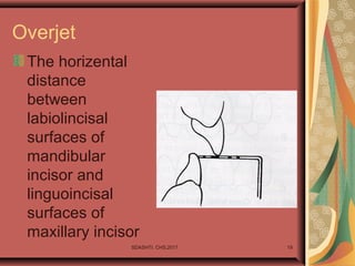 Overjet
The horizental
distance
between
labiolincisal
surfaces of
mandibular
incisor and
linguoincisal
surfaces of
maxillary incisor
SDASHTI. CHS,2017 19
 