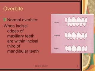 Overbite
Normal overbite:
When incisal
edges of
maxillary teeth
are within incisal
third of
mandibular teeth
SDASHTI. CHS,2017 20
 