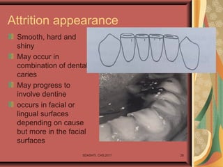 Attrition appearance
Smooth, hard and
shiny
May occur in
combination of dental
caries
May progress to
involve dentine
occurs in facial or
lingual surfaces
depending on cause
but more in the facial
surfaces
SDASHTI. CHS,2017 28
 
