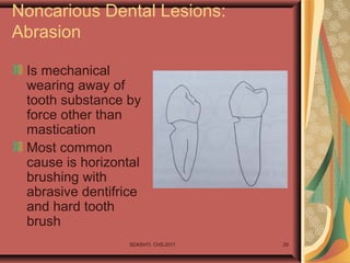 SDASHTI. CHS,2017 29
Noncarious Dental Lesions:
Abrasion
Is mechanical
wearing away of
tooth substance by
force other than
mastication
Most common
cause is horizontal
brushing with
abrasive dentifrice
and hard tooth
brush
 