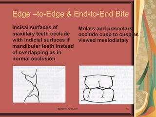 End To End Bite Teeth