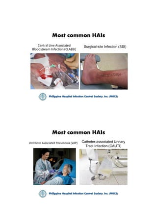 Most common HAIs
Central Line Associated
Bloodstream Infection (CLABSI)
Surgical-site Infection (SSI)
Most common HAIs
Ven...