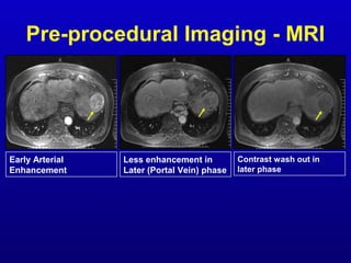 Pre-procedural Imaging - MRI

Early Arterial
Enhancement

Less enhancement in
Later (Portal Vein) phase

Contrast wash out...