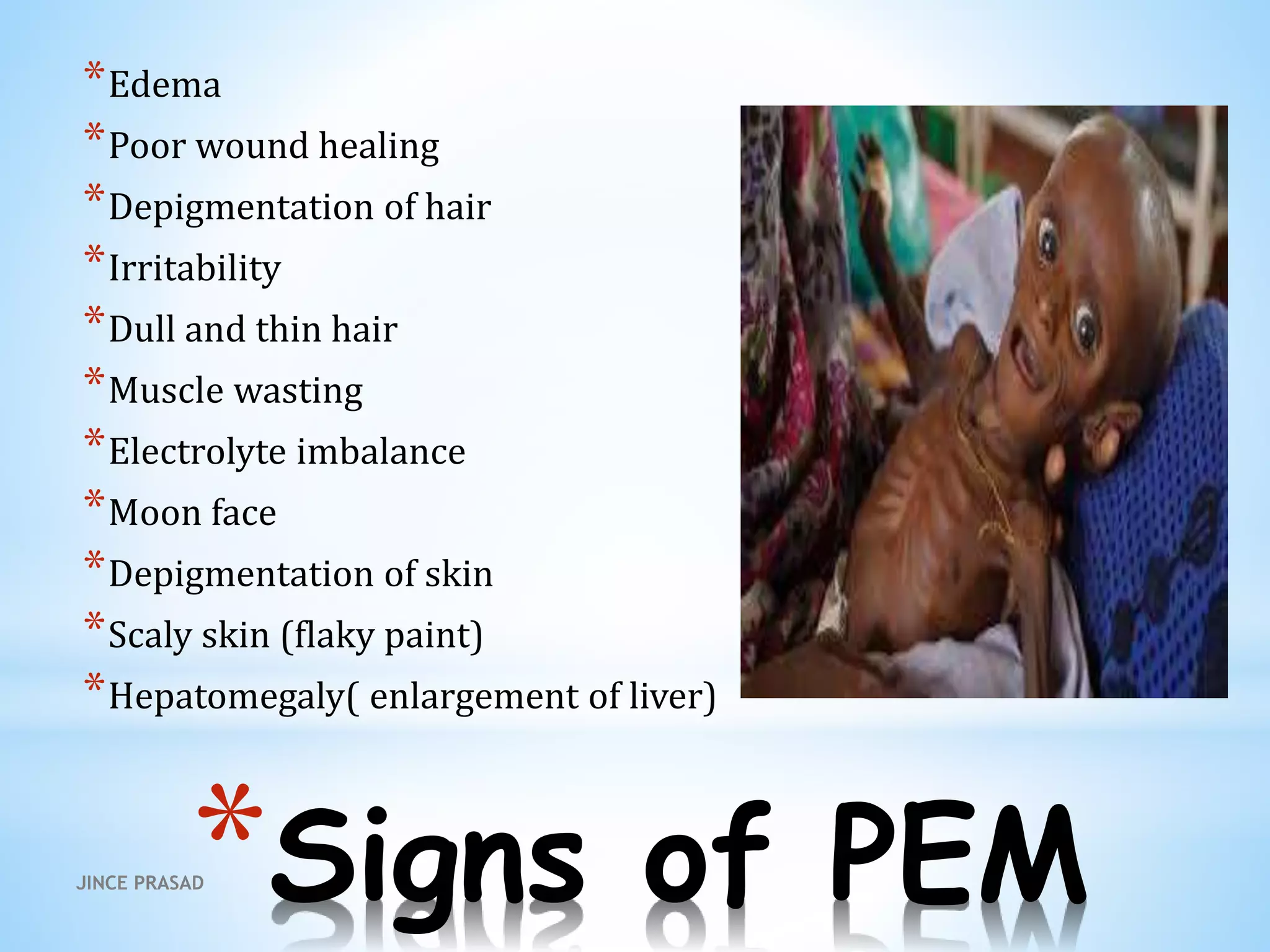 *Signs of PEM
*Edema
*Poor wound healing
*Depigmentation of hair
*Irritability
*Dull and thin hair
*Muscle wasting
*Electrolyte imbalance
*Moon face
*Depigmentation of skin
*Scaly skin (flaky paint)
*Hepatomegaly( enlargement of liver)
JINCE PRASAD
 