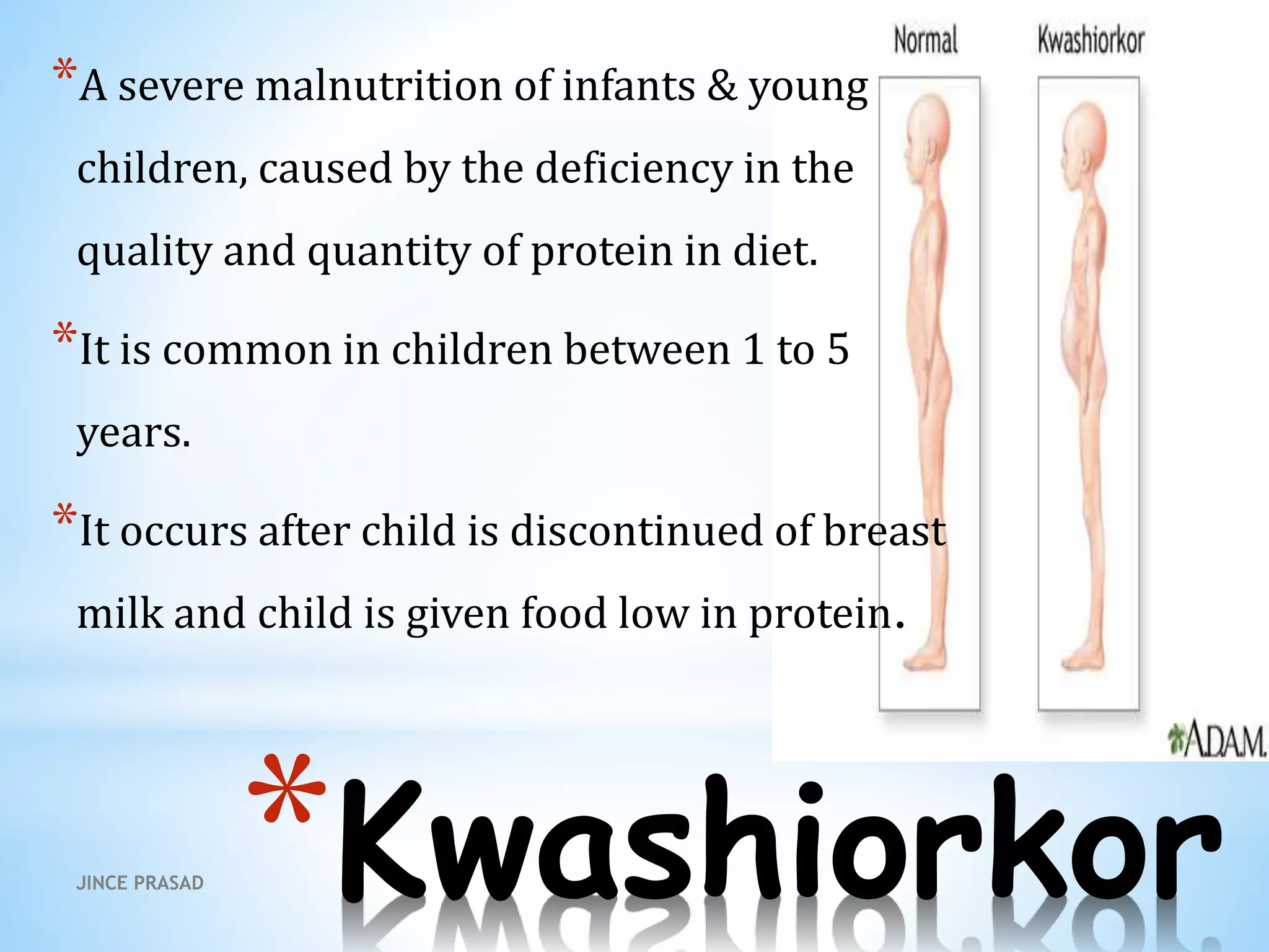 *Kwashiorkor
*A severe malnutrition of infants & young
children, caused by the deficiency in the
quality and quantity of protein in diet.
*It is common in children between 1 to 5
years.
*It occurs after child is discontinued of breast
milk and child is given food low in protein.
JINCE PRASAD
 