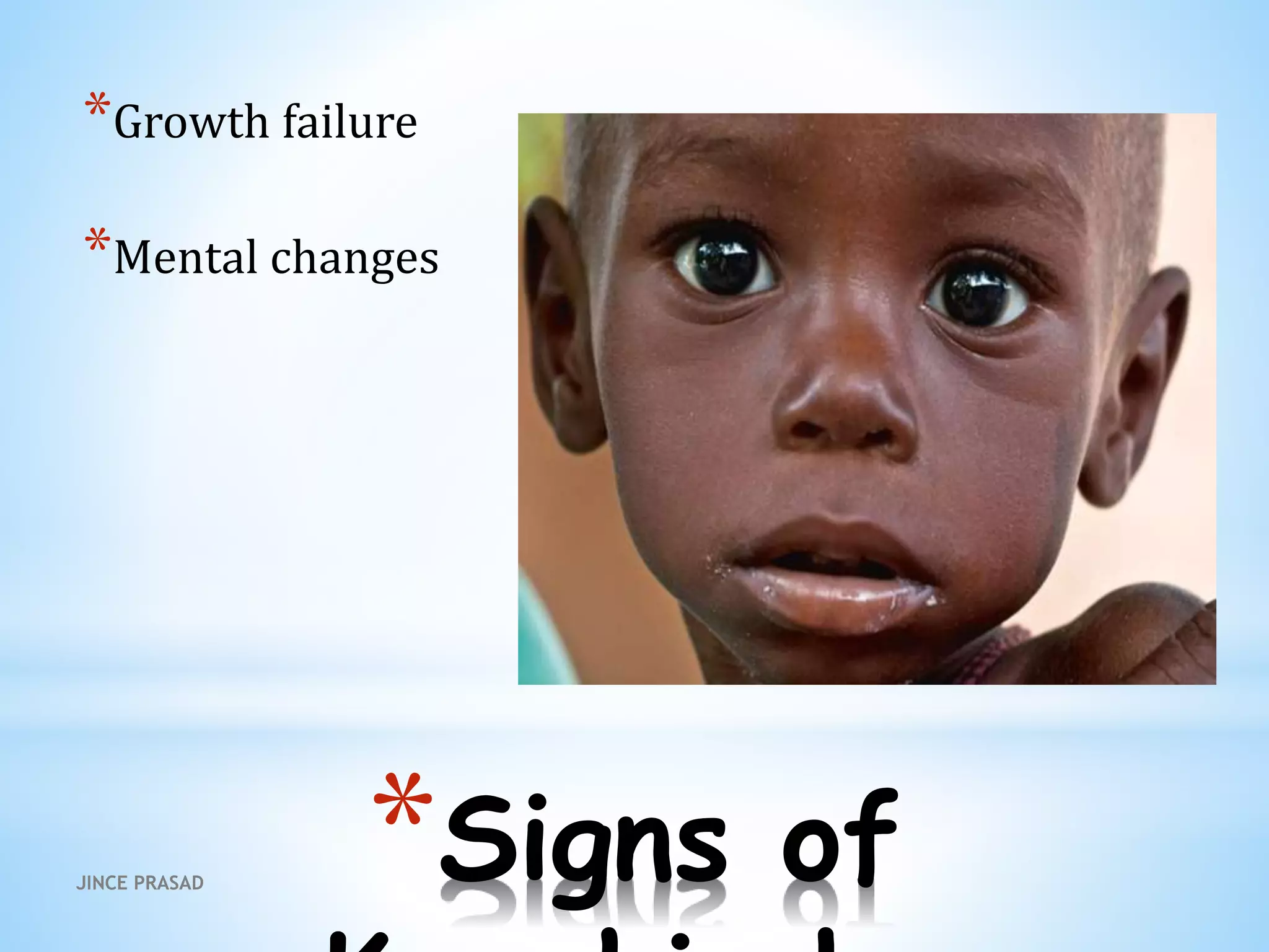 *Signs of
*Growth failure
*Mental changes
JINCE PRASAD
 