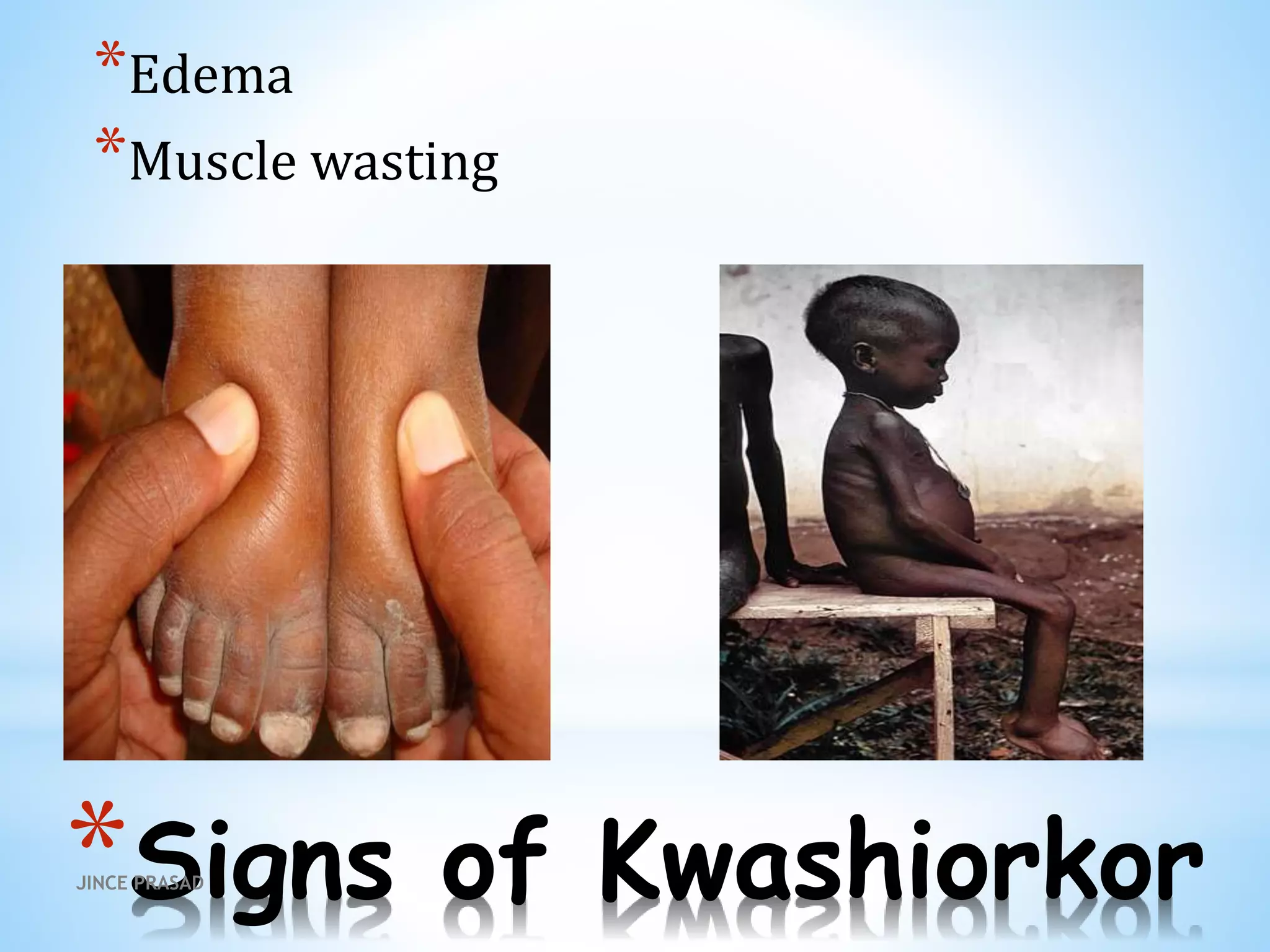 *Signs of Kwashiorkor
*Edema
*Muscle wasting
JINCE PRASAD
 