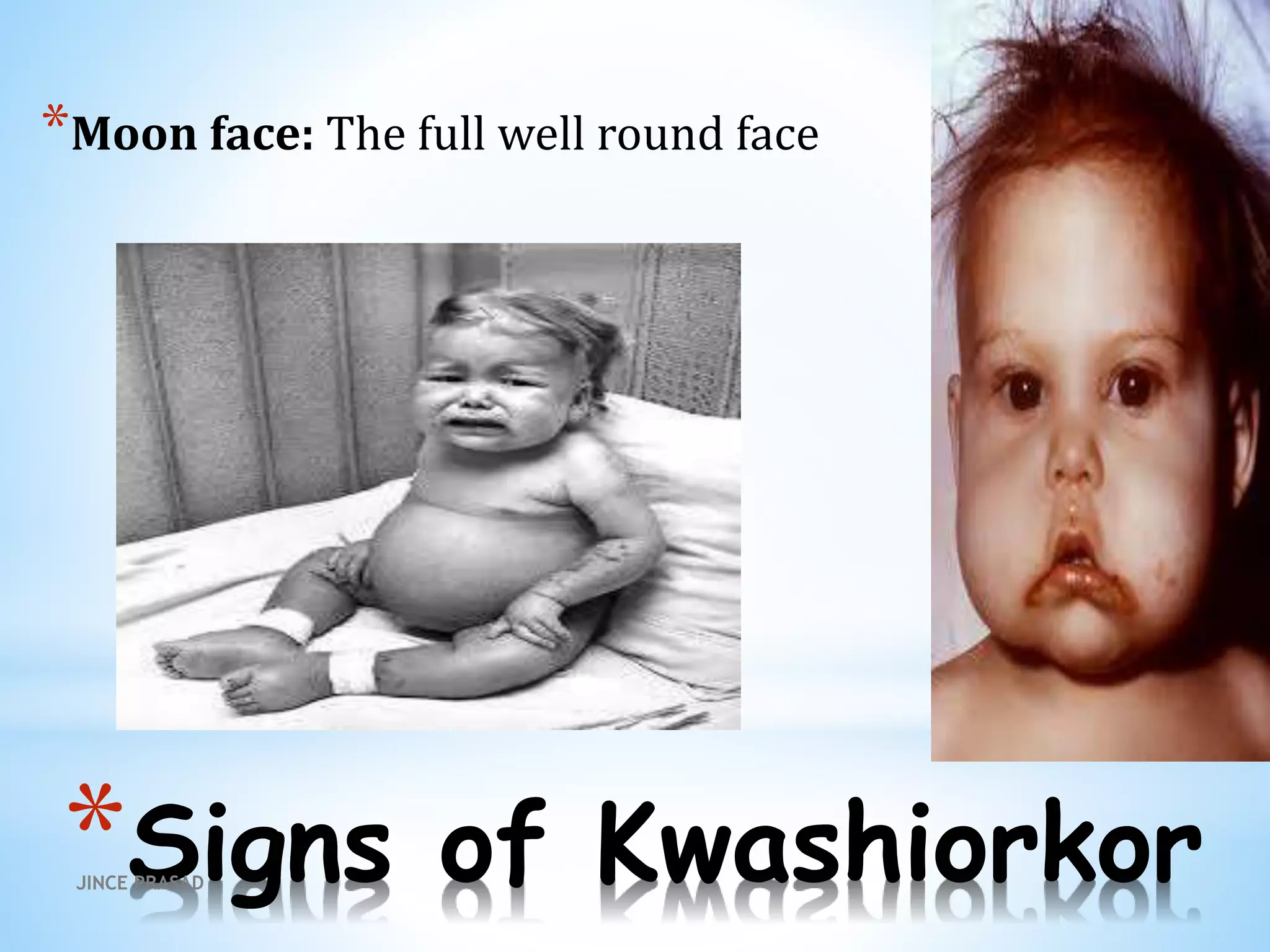 *Signs of Kwashiorkor
*Moon face: The full well round face
JINCE PRASAD
 