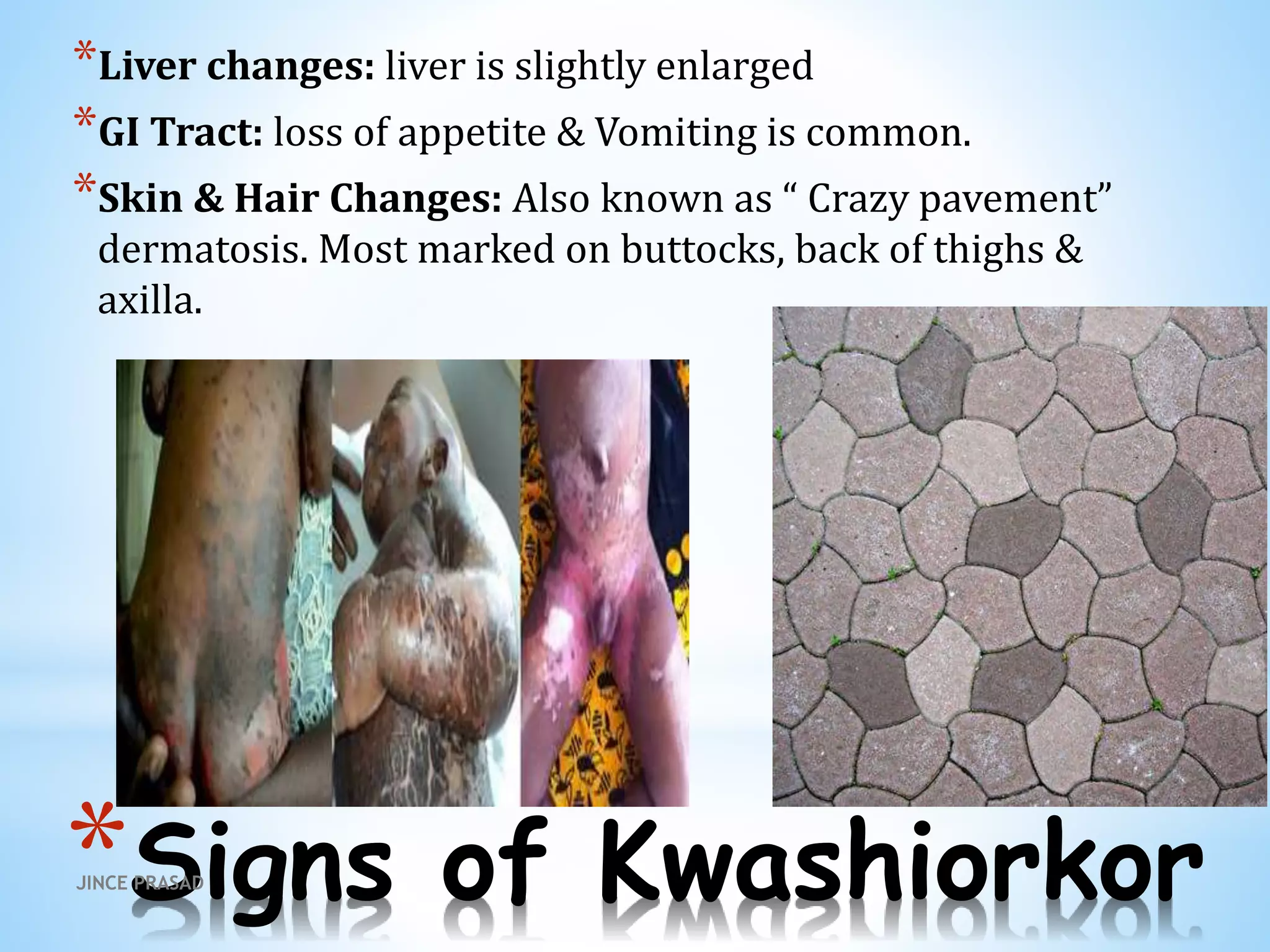 *Signs of Kwashiorkor
*Liver changes: liver is slightly enlarged
*GI Tract: loss of appetite & Vomiting is common.
*Skin & Hair Changes: Also known as “ Crazy pavement”
dermatosis. Most marked on buttocks, back of thighs &
axilla.
JINCE PRASAD
 