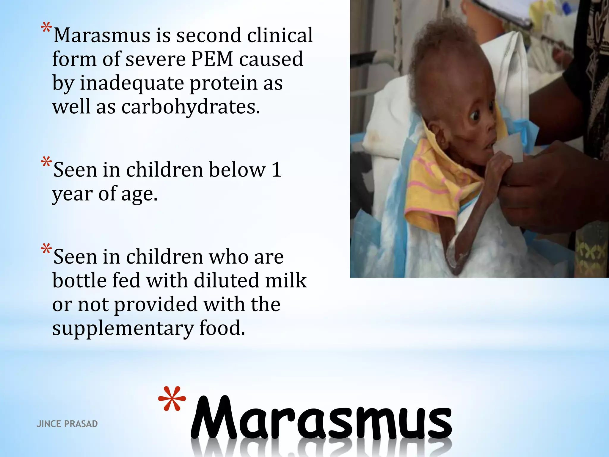 *Marasmus
*Marasmus is second clinical
form of severe PEM caused
by inadequate protein as
well as carbohydrates.
*Seen in children below 1
year of age.
*Seen in children who are
bottle fed with diluted milk
or not provided with the
supplementary food.
JINCE PRASAD
 