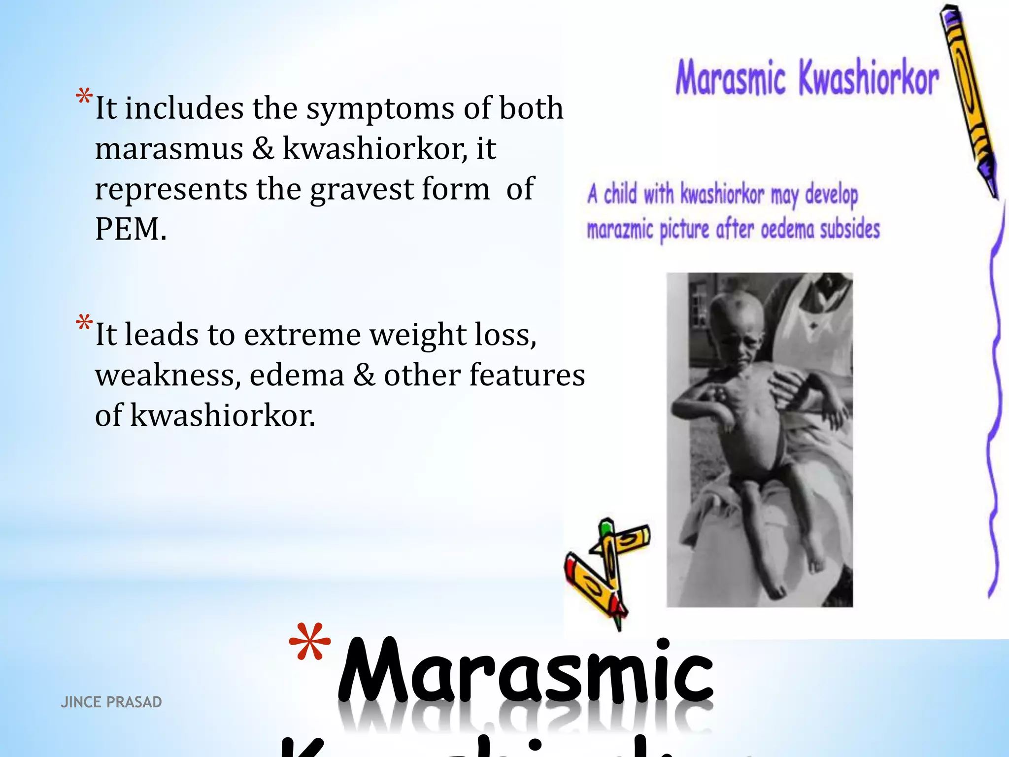 *Marasmic
*It includes the symptoms of both
marasmus & kwashiorkor, it
represents the gravest form of
PEM.
*It leads to extreme weight loss,
weakness, edema & other features
of kwashiorkor.
JINCE PRASAD
 