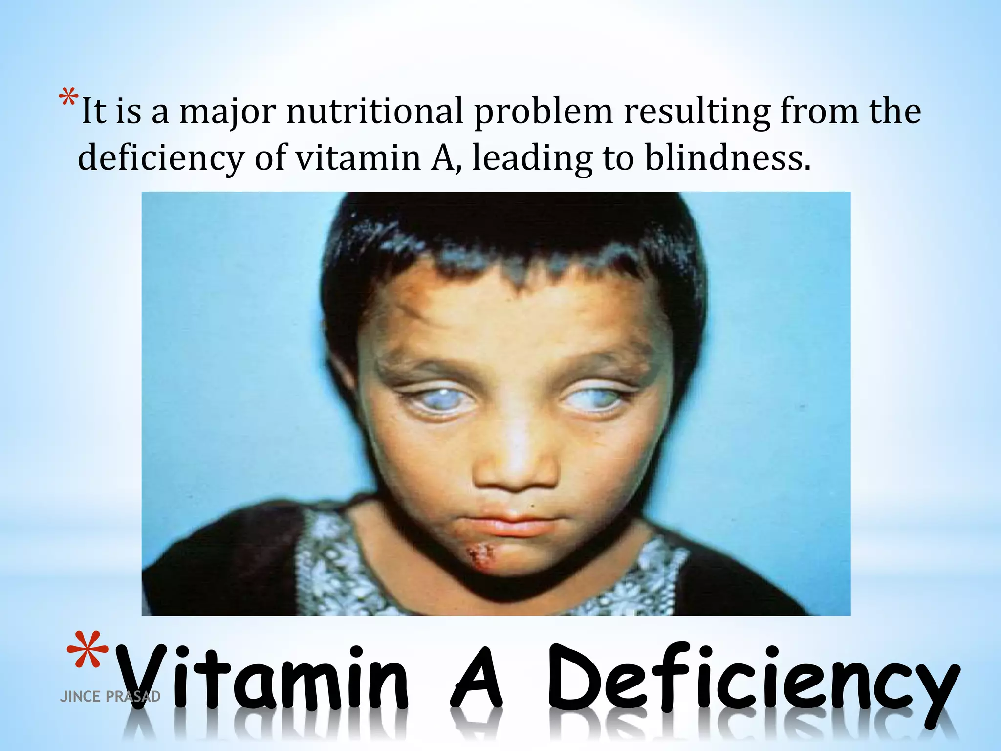 *Vitamin A Deficiency
*It is a major nutritional problem resulting from the
deficiency of vitamin A, leading to blindness.
JINCE PRASAD
 