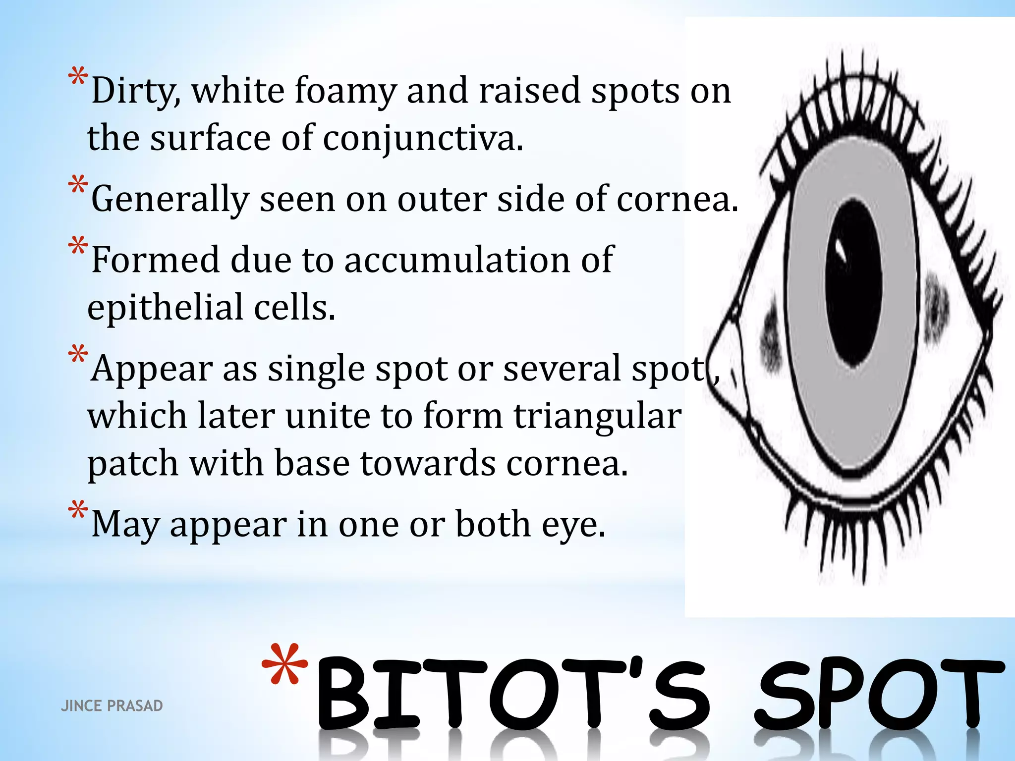 *BITOT’S SPOT
*Dirty, white foamy and raised spots on
the surface of conjunctiva.
*Generally seen on outer side of cornea.
*Formed due to accumulation of
epithelial cells.
*Appear as single spot or several spot ,
which later unite to form triangular
patch with base towards cornea.
*May appear in one or both eye.
JINCE PRASAD
 