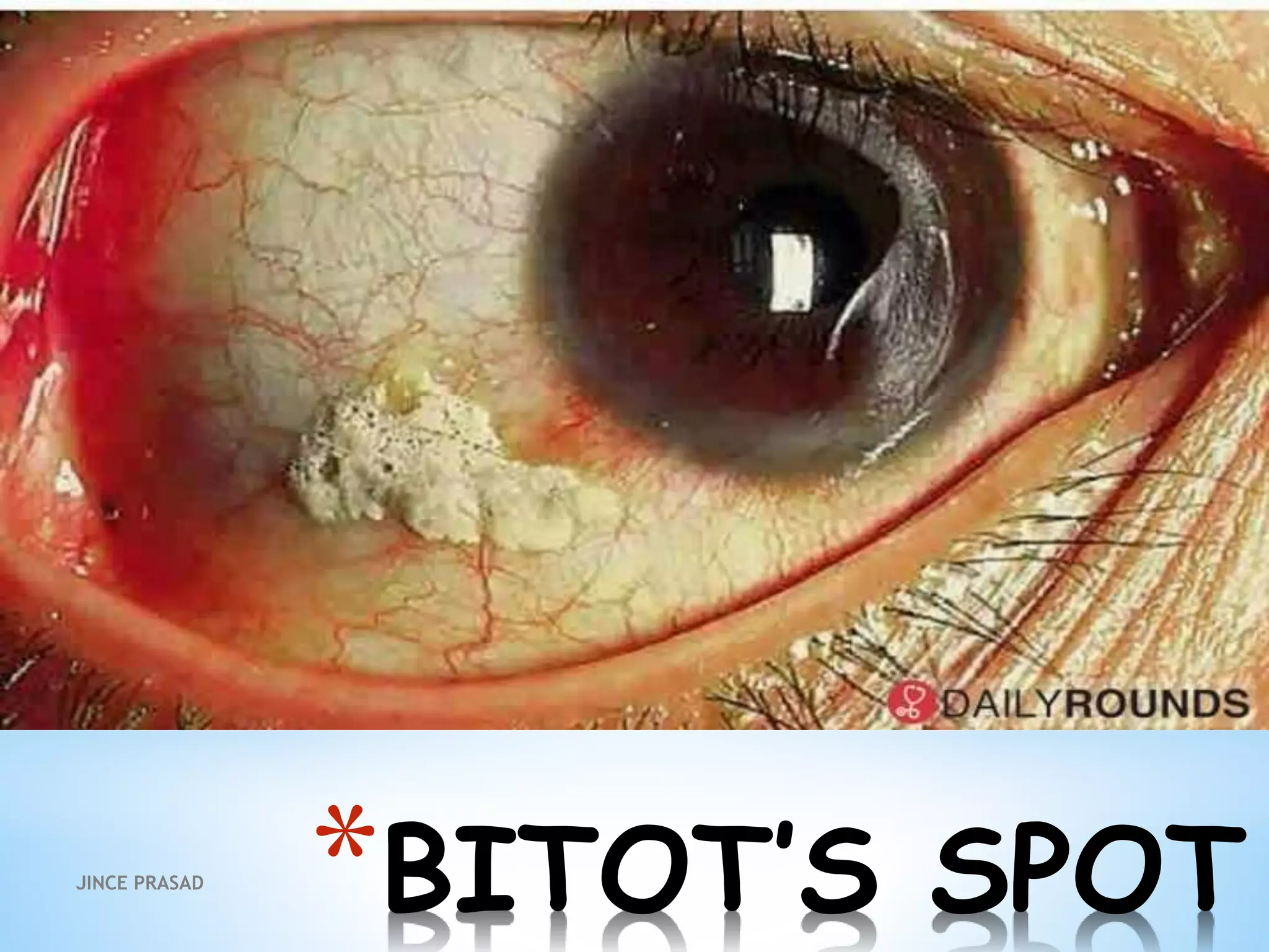 *BITOT’S SPOTJINCE PRASAD
 