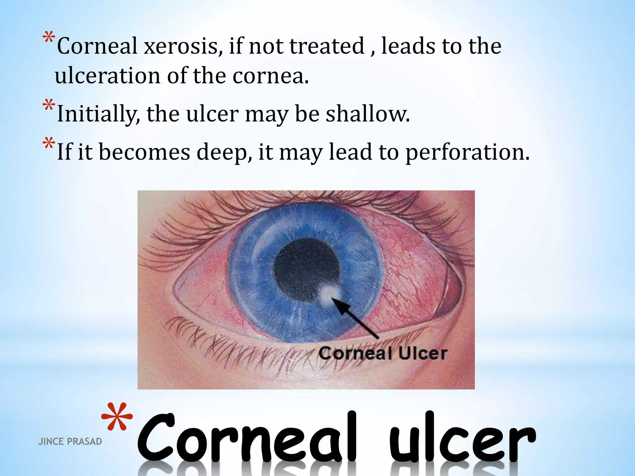 *Corneal ulcer
*Corneal xerosis, if not treated , leads to the
ulceration of the cornea.
*Initially, the ulcer may be shallow.
*If it becomes deep, it may lead to perforation.
JINCE PRASAD
 