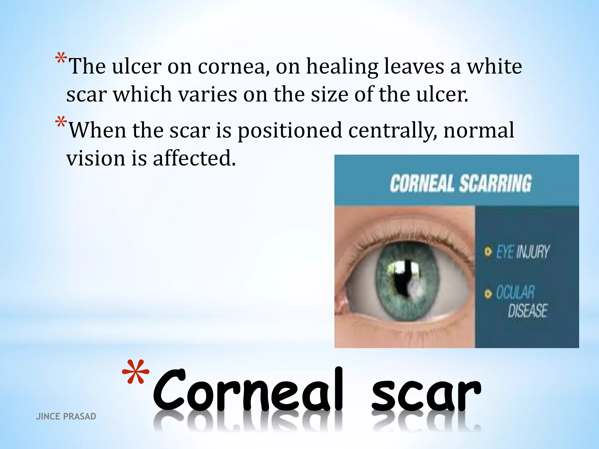 *Corneal scar
*The ulcer on cornea, on healing leaves a white
scar which varies on the size of the ulcer.
*When the scar is positioned centrally, normal
vision is affected.
JINCE PRASAD
 