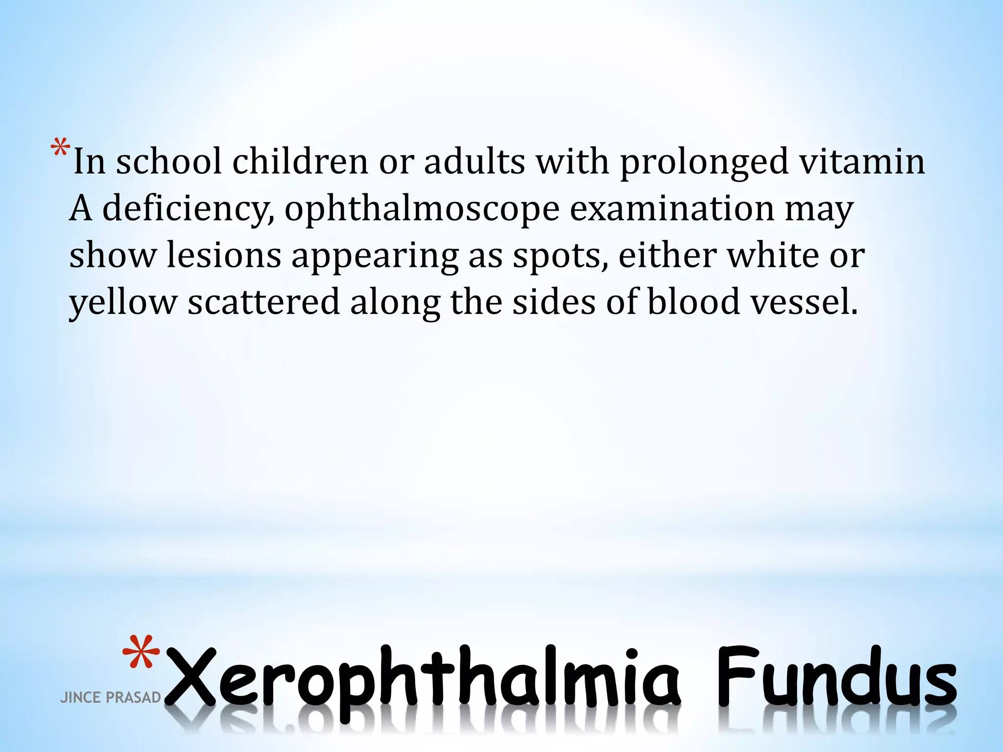 *Xerophthalmia Fundus
*In school children or adults with prolonged vitamin
A deficiency, ophthalmoscope examination may
show lesions appearing as spots, either white or
yellow scattered along the sides of blood vessel.
JINCE PRASAD
 