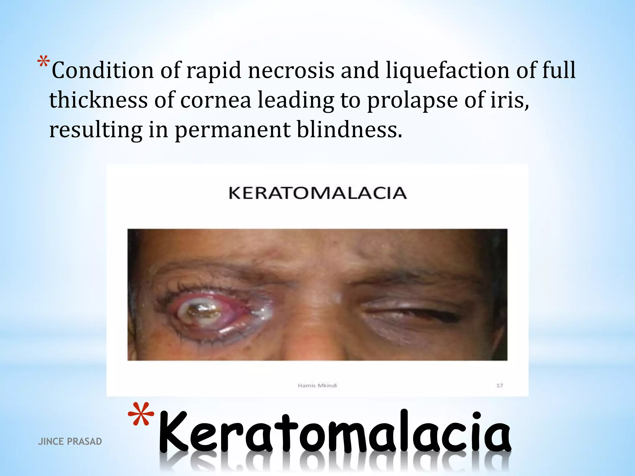 *Keratomalacia
*Condition of rapid necrosis and liquefaction of full
thickness of cornea leading to prolapse of iris,
resulting in permanent blindness.
JINCE PRASAD
 