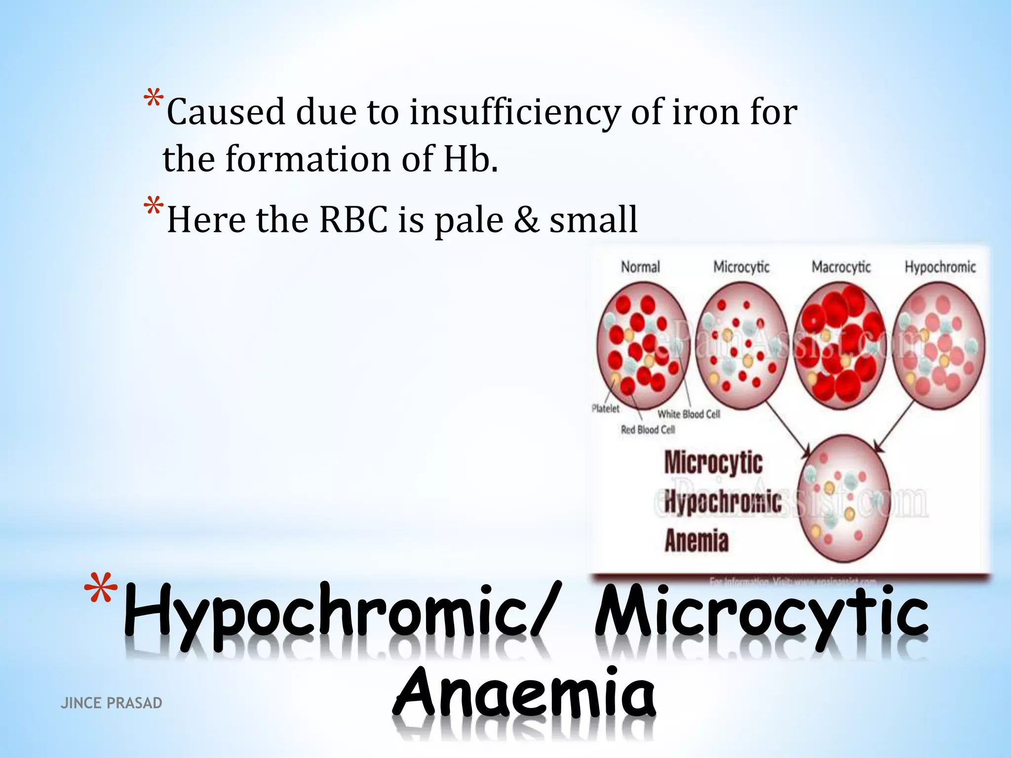 *Hypochromic/ Microcytic
Anaemia
*Caused due to insufficiency of iron for
the formation of Hb.
*Here the RBC is pale & small
JINCE PRASAD
 