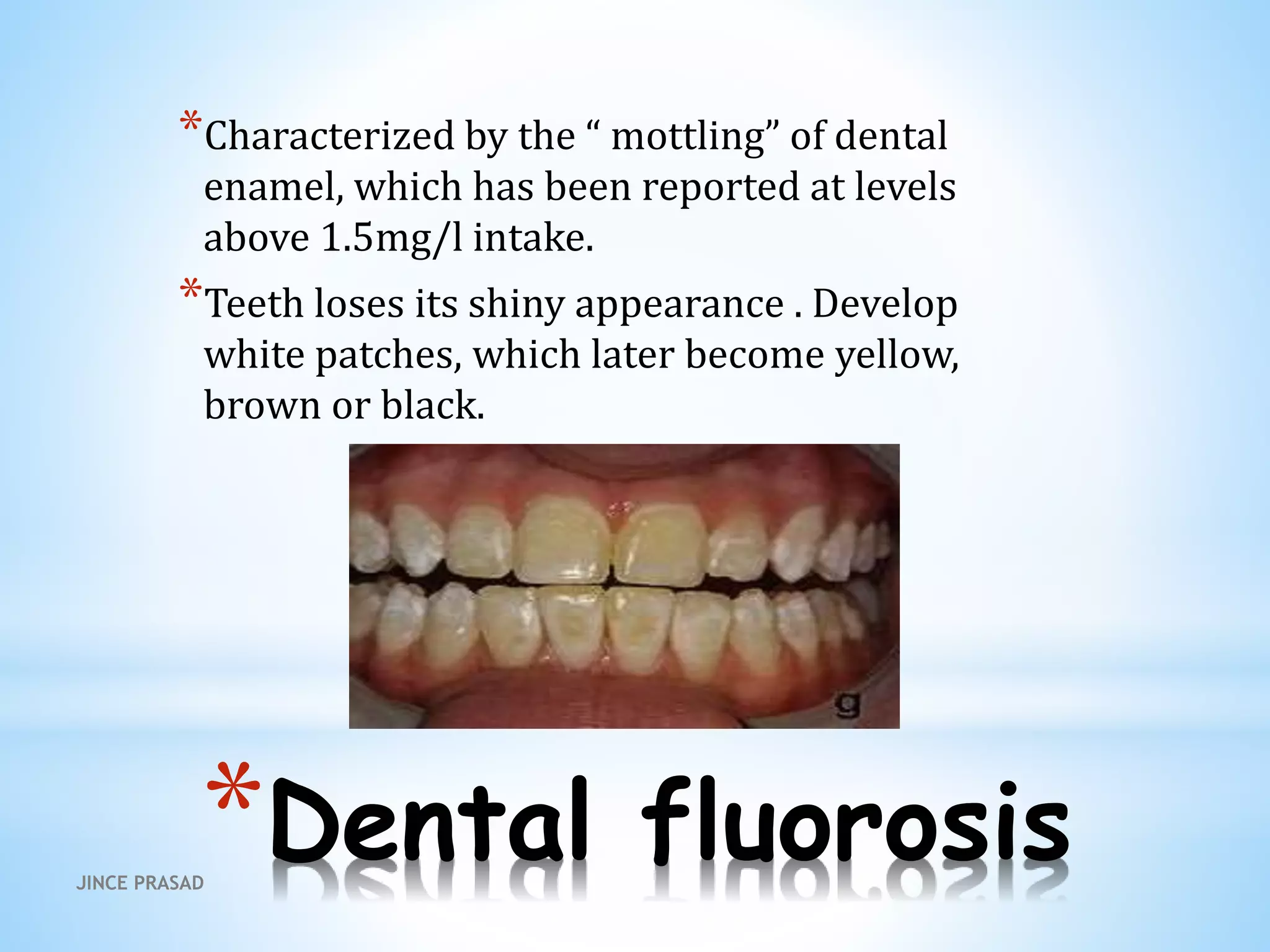 *Dental fluorosis
*Characterized by the “ mottling” of dental
enamel, which has been reported at levels
above 1.5mg/l intake.
*Teeth loses its shiny appearance . Develop
white patches, which later become yellow,
brown or black.
JINCE PRASAD
 