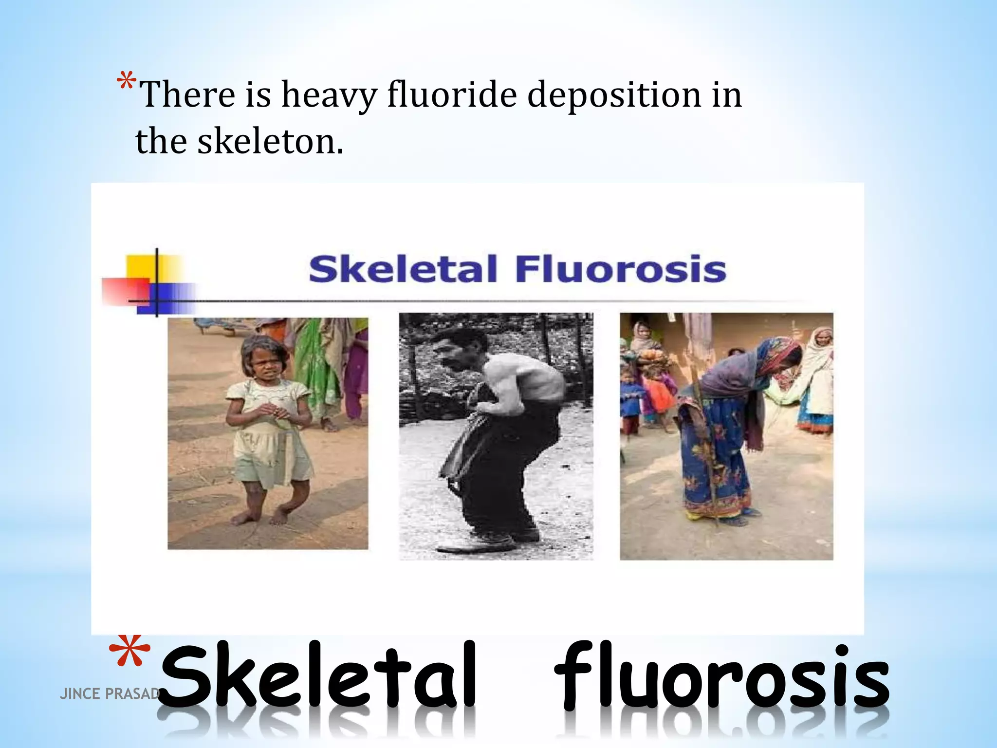 *Skeletal fluorosis
*There is heavy fluoride deposition in
the skeleton.
JINCE PRASAD
 
